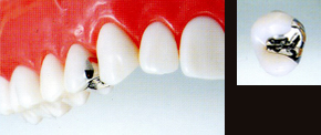 銀歯（保険適用金属）画像