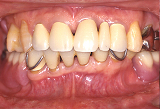 歯周病治療症例